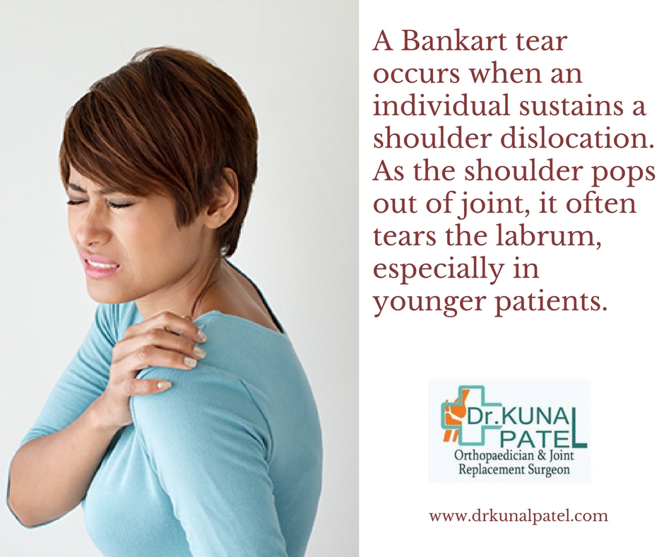 Bankart Shoulder Injury