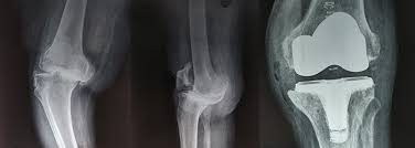 Best Total Knee Replacement Surgeon in Mumbai.