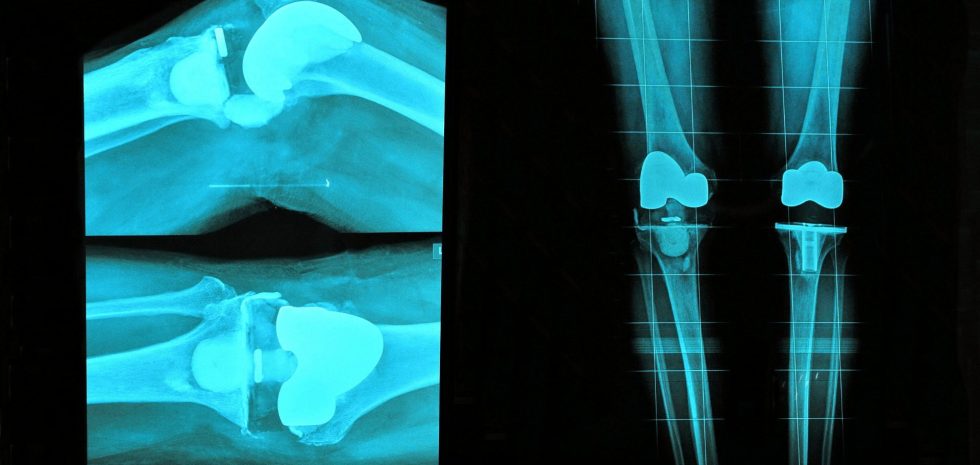 Best Partial Knee Replacement Surgeon in Mumbai