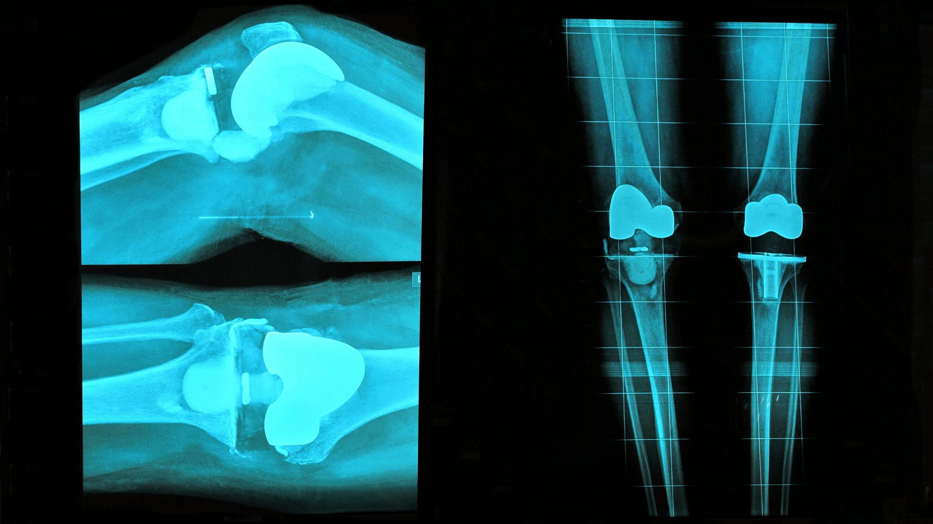 Best Partial Knee Replacement Surgeon in Mumbai