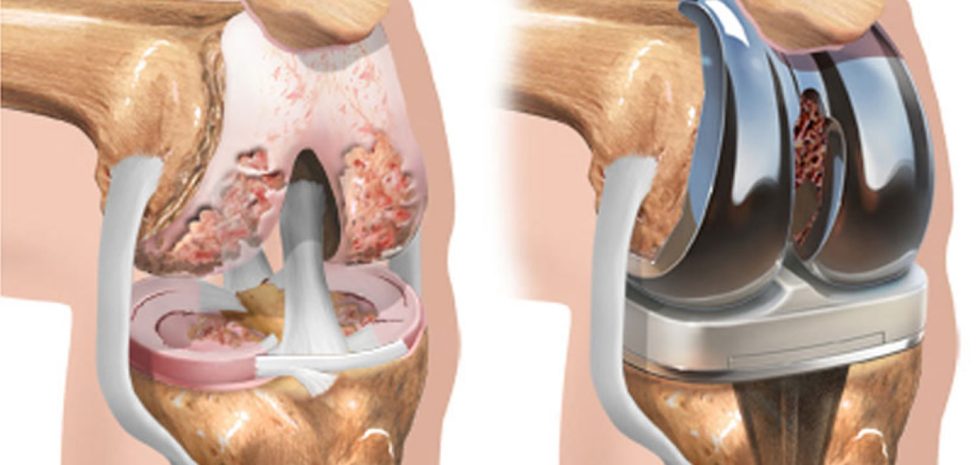 knee replacement in Mumbai