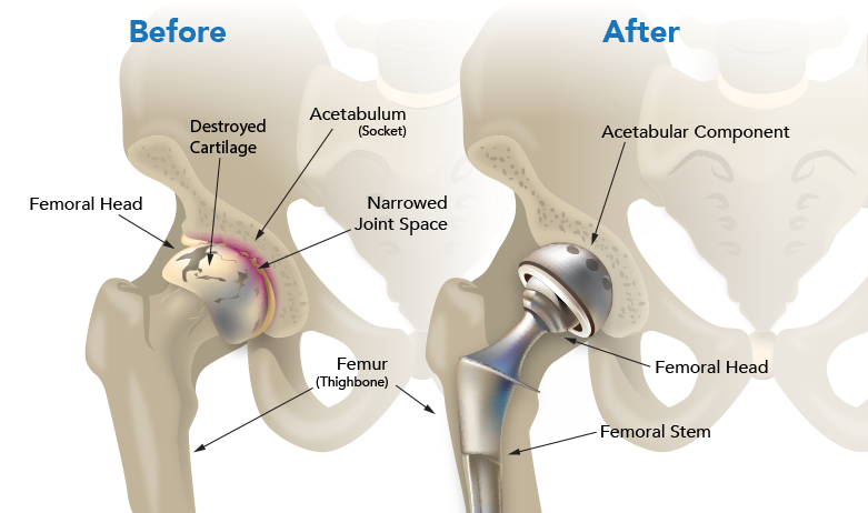 best joint replacement surgeon in Mumbai