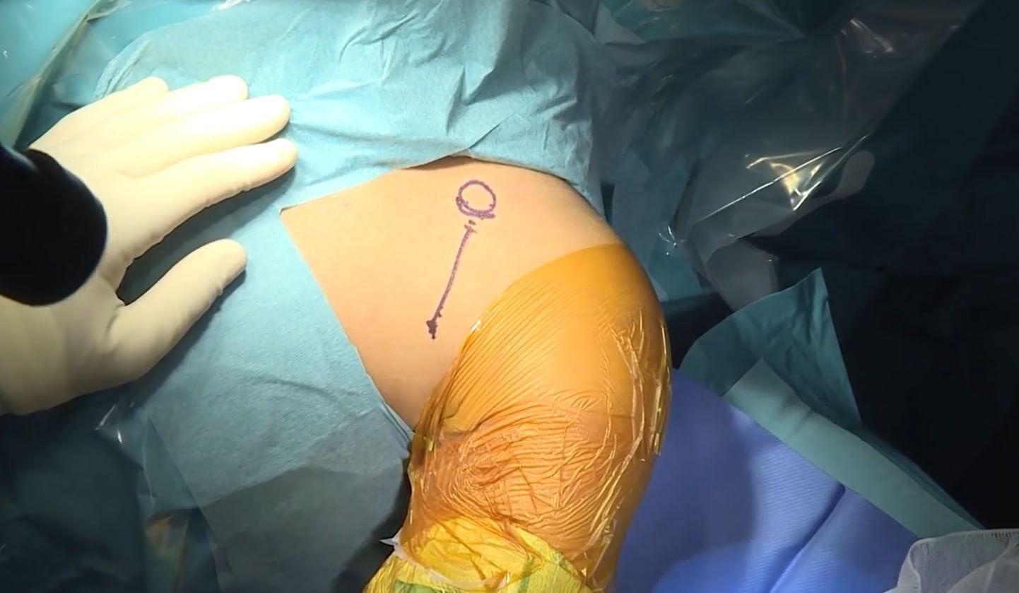 best shoulder arthroscopy specialists in Mumbai