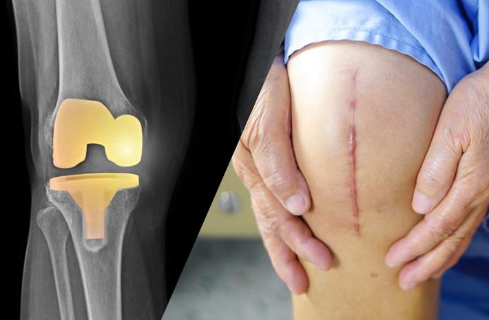 best total knee replacement surgeon in Mumbai