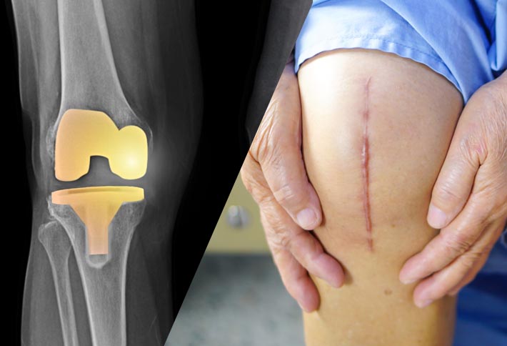 best total knee replacement surgeon in Mumbai