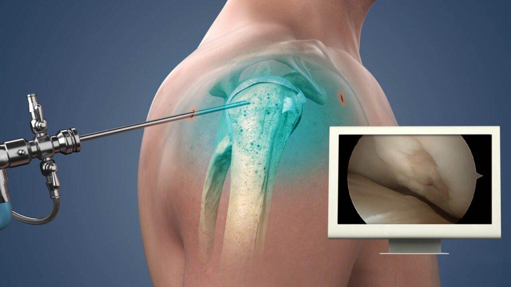 Best Shoulder Arthroscopy Surgeon in Mumbai